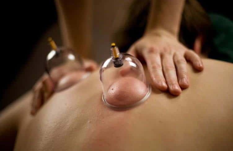 cupping_therapy