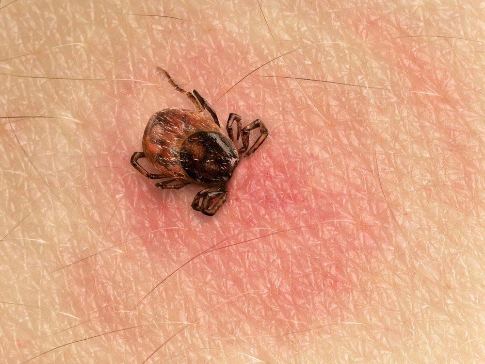 Lyme Disease_53022467 S CdSxcU_DP