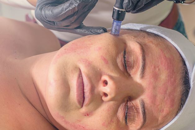 Facial Acupuncture Vs Microneedling